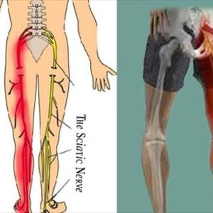 Exercise For Sciatica Back Pain - Sciatica Symptoms