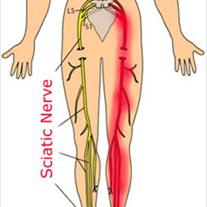 Sciatica Exercises To Relieve Pain - The Best & Quickest Exercise To Relieve Sciatica