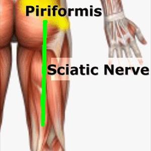 Leg Sciatica - Sciatica- Causes And Treatments: Savannah, GA. Jacksonville, FL.