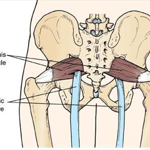 Treatment For Sciatic Nerve - Information On Sciatica