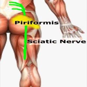 Relief From Sciatica - Sciatica Pain Relief