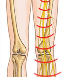 Raj Sciatic Block - Physical Therapy For Sciatica Pain Relief