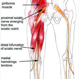 Sciatica Herbal Treatment - Exercises  For Sciatica