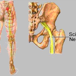 Sciatic Nerve Inflammation - Avoid The Top 3 Sciatica Mistakes!